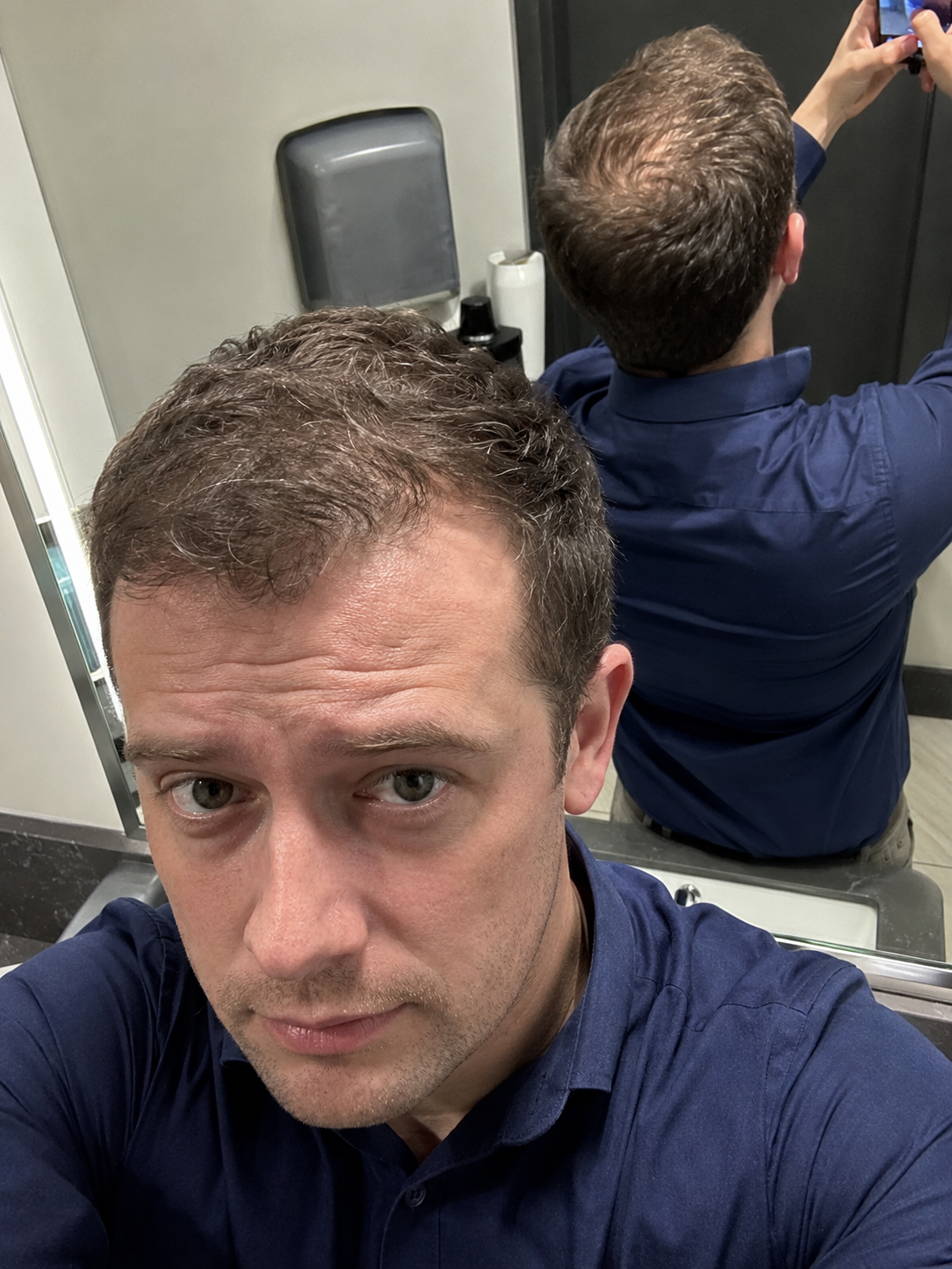Receding hairline